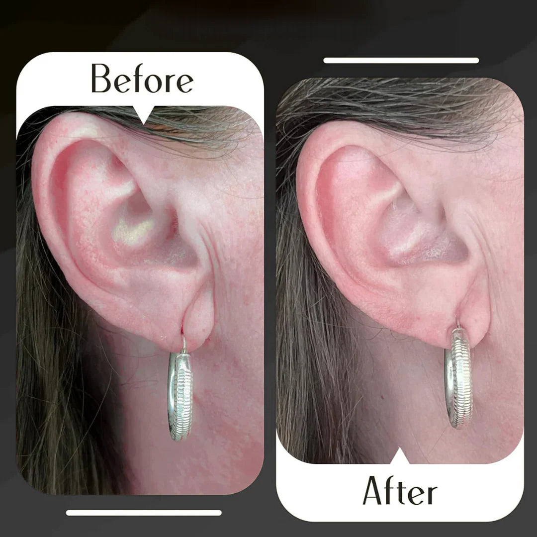 Lobewonder™️ Earlobe Support Patches (100 PCS)