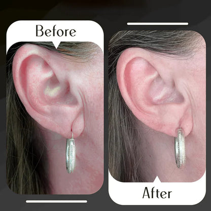 Lobewonder™️ Earlobe Support Patches (100 PCS)